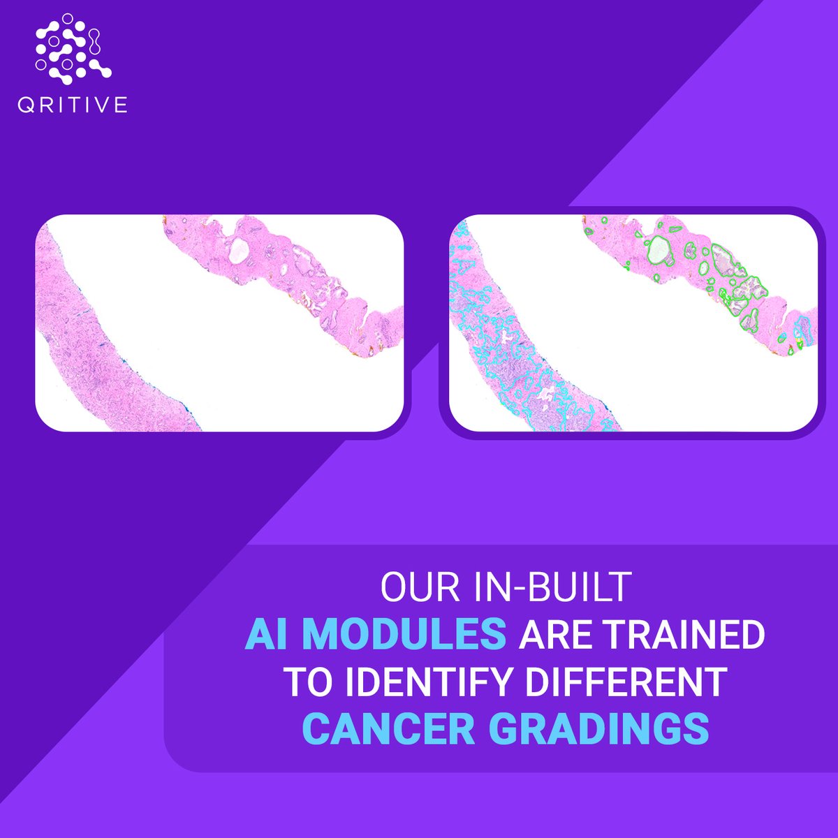 Our flagship product, Pantheon, helps #pathologists digitize their entire workflow through a case management system, digital slide viewer, in-built #AI features to identify different #cancer gradings and a report generation system. To learn more, visit: qritive.com/products.