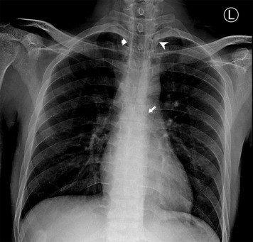 ACEPNation's tweet photo. #FOAMed Case: https://t.co/vDwBgH5jX5

• 21 y/o male with acute chest and neck pain after a visit to karaoke
• PT was afebrile, with a blood pressure of 115/57 mm Hg, a pulse rate of 99 beats/min, a respiratory rate of 16 breaths/min, and a peripheral oxygen saturation of 99% https://t.co/tn4cEGqVs9