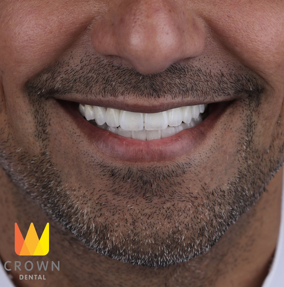 CrownDentalkw's tweet photo. تبديل تركيبات الأسنان القديمة بتركيبات طبيعية. 
 التجميل الطبيعي!. https://t.co/LxP9ILE39V