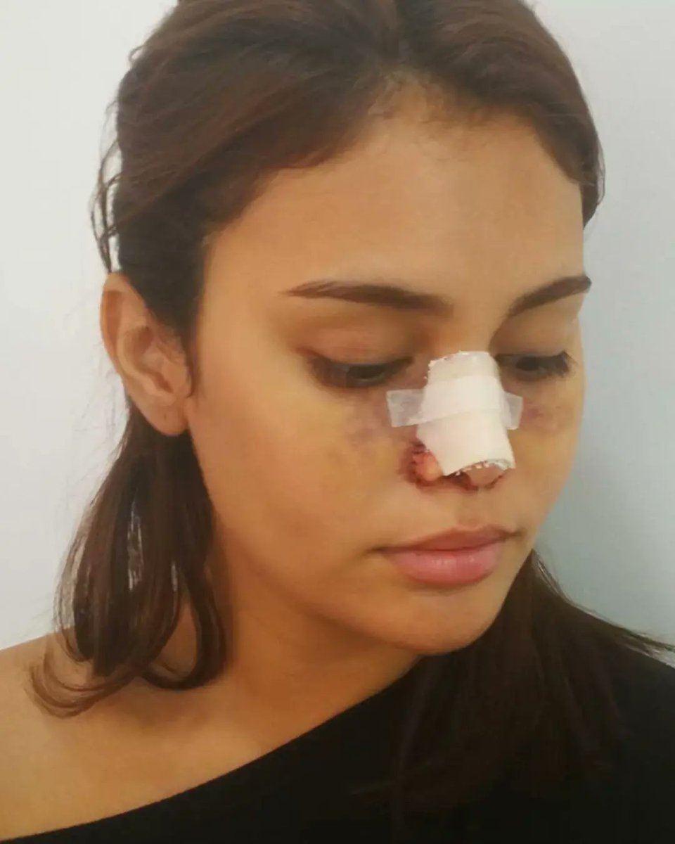 ivaniansOFC's tweet photo. #Repost @staceyalette

Nose job makeup I did on Ms. @IvanaAlawi 👸🦋for her YouTube vlog ✨
@IvanaSkin

https://t.co/aqvbMLmQMP

#sfx #sfxmakeup #nosejob #rhinoplasty #sfxph #sfxmua #specialeffects #specialeffectsmakeup #makeup #mua #muaph #ivanaalawi https://t.co/0pgW8S0qct