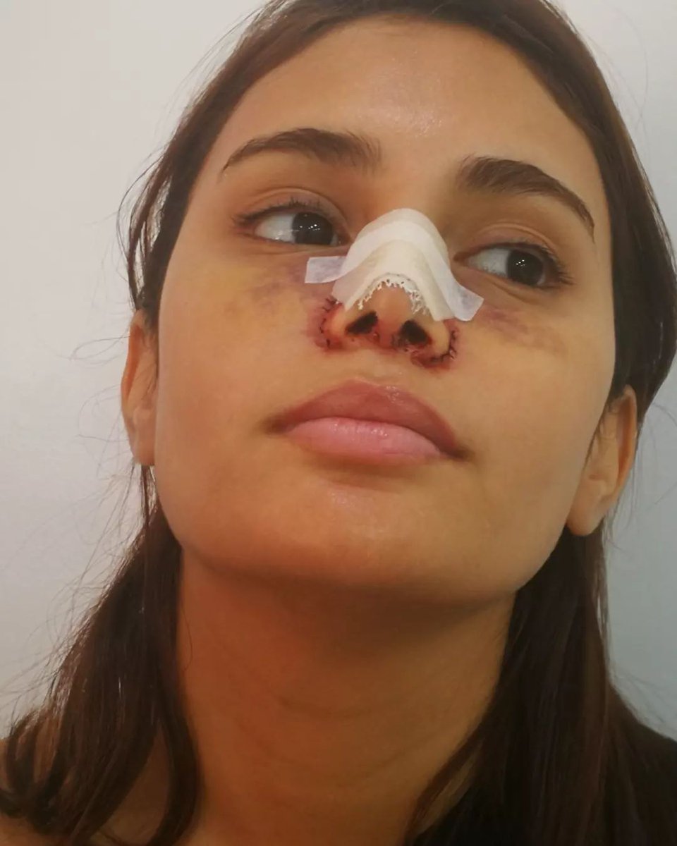 ivaniansOFC's tweet photo. #Repost @staceyalette

Nose job makeup I did on Ms. @IvanaAlawi 👸🦋for her YouTube vlog ✨
@IvanaSkin

https://t.co/aqvbMLmQMP

#sfx #sfxmakeup #nosejob #rhinoplasty #sfxph #sfxmua #specialeffects #specialeffectsmakeup #makeup #mua #muaph #ivanaalawi https://t.co/0pgW8S0qct