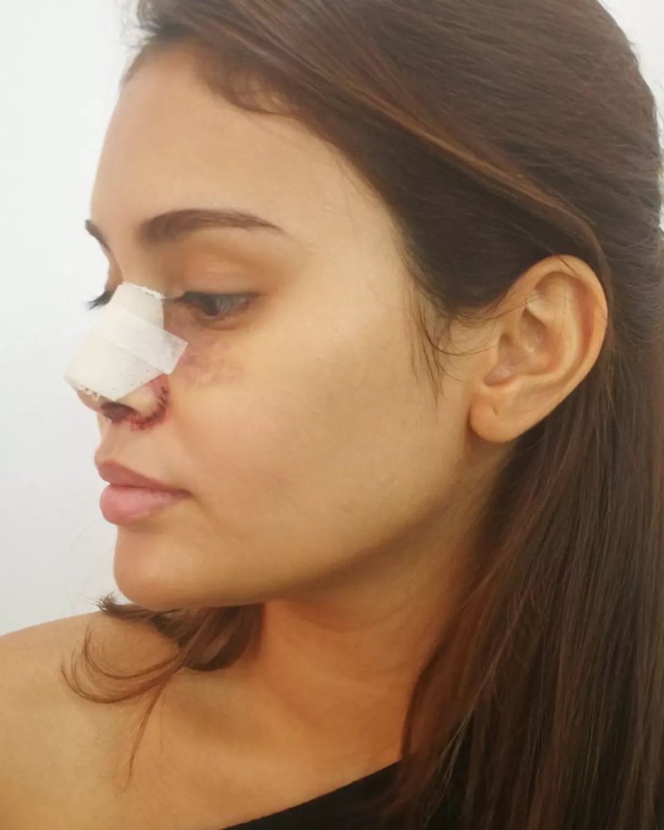 ivaniansOFC's tweet photo. #Repost @staceyalette

Nose job makeup I did on Ms. @IvanaAlawi 👸🦋for her YouTube vlog ✨
@IvanaSkin

https://t.co/aqvbMLmQMP

#sfx #sfxmakeup #nosejob #rhinoplasty #sfxph #sfxmua #specialeffects #specialeffectsmakeup #makeup #mua #muaph #ivanaalawi https://t.co/0pgW8S0qct
