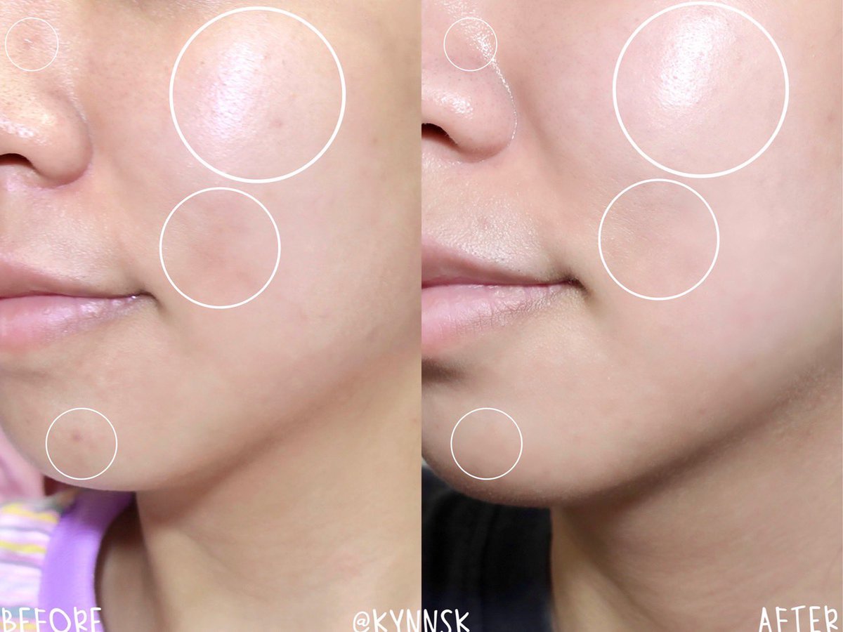 kynnsk's tweet photo. เห็นคนอื่นเค้ารีวิวเยอะ ก็ต้องลองซะหน่อยแล้วป่าว Garnier Vitamin C Ampoule Serum ✨ แอมพูลเข้มข้น แต่เนื้อไม่เหนอะหนะ และซึมไวมากๆ กู้ผิวแบบเร่งด่วนได้ดีสุดๆ รอยดำจางไว ผิวดูกระจ่างใสขึ้น ใครนอนดึกหน้าโทรมหรือมีปัญหาผิวหมองคล้ำแนะนำเลย ✨ #ใช้ดีบอกต่อ https://t.co/ETBNudfTQb