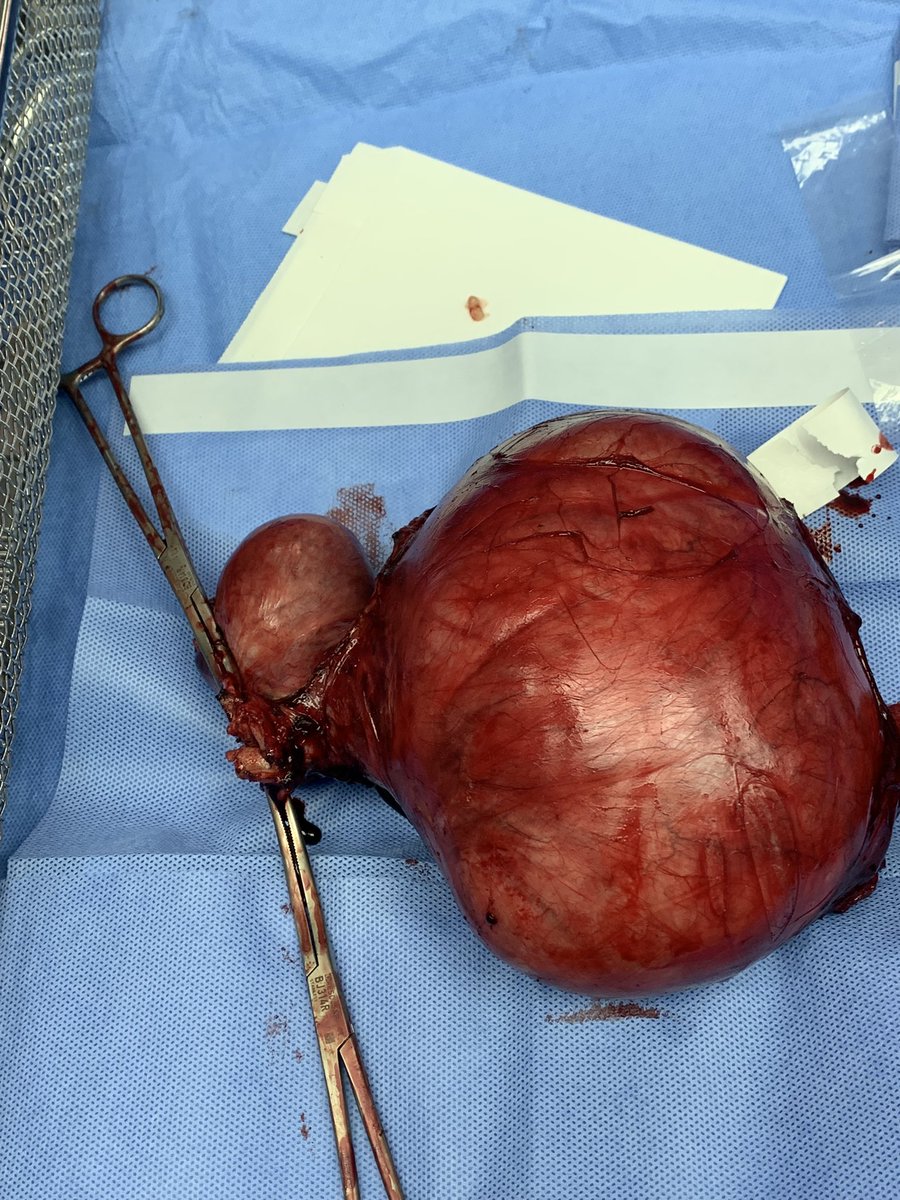 ammarazzawi's tweet photo. Huge Myoma #hystrectomy https://t.co/UfCnq0kYwD