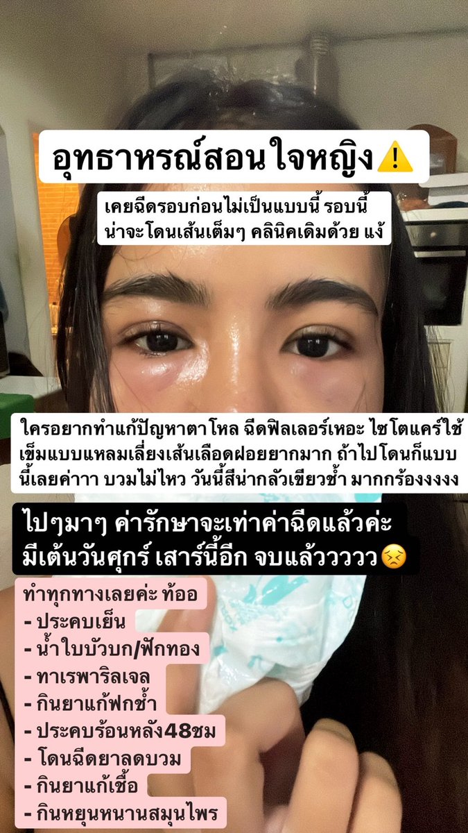 mellowemochi's tweet photo. อุทธาหรณ์ใครสายฉีดคิดดีๆก่อนค่ะ ฮืออ ใครตาโหล นอนน้อย เราขอแนะนำไปฟิลเลอร์เลยค่ะ อย่าเสี่ยงกับเข็มปลายแหลมเลย พลาดเข้าเส้นเลือดง่ายมาก แล้วจะเป็นแบบเรา ใครอยากดูเพิ่มเติมเดี๋ยวมาต่อในเธรดนะคะ #HowtoPerfect #ไว้รีวิวห้ามขายของโว้ยย https://t.co/dqwMToEDmV
