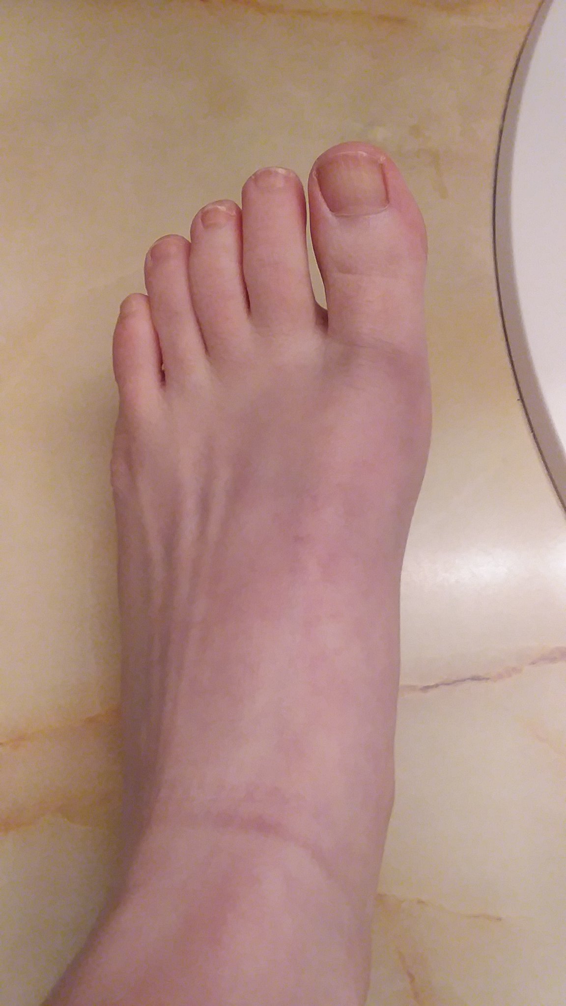 top-of-foot-swollen-after-dropping-something-on-it-store