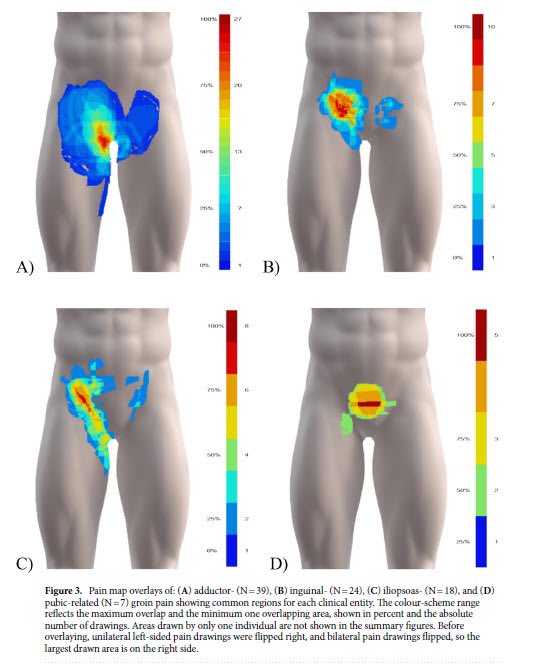 Andreas Serner (@aserner) on Twitter photo New study out with a NEW FOCUS on groin pain!
We investigated self-reported pain quality and location and compared that to the clinical diagnoses
Open access <a href="/SciReports/">Scientific Reports</a>
nature.com/articles/s4159… New study out with a NEW FOCUS on groin pain!
We investigated self-reported pain quality and location and compared that to the clinical diagnoses
Open access <a href="/SciReports/">Scientific Reports</a>
nature.com/articles/s4159…