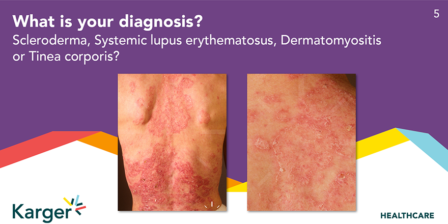 HealthKarger's tweet photo. #Dermatologists probably already know what we're looking at here - so drop us your answer in the comments
#DermaQuiz #KargerHCP https://t.co/2YZoJktH6z