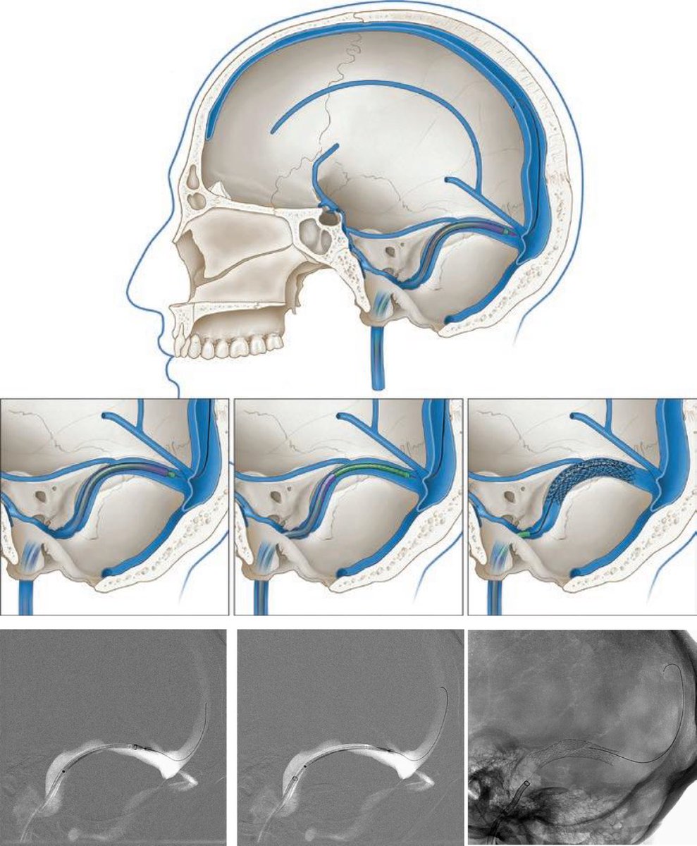 Alex Spiotta (@alex_spiotta) on Twitter photo Donāt Underestimate the impact of key illustrations paired with fluoro images to convey key procedural steps and concepts. Make friends with a talented artist ! ā¦<a href="/HolyCityNsgy/">MUSC Neurosurgery</a>ā© Donāt Underestimate the impact of key illustrations paired with fluoro images to convey key procedural steps and concepts. Make friends with a talented artist ! ā¦<a href="/HolyCityNsgy/">MUSC Neurosurgery</a>ā©