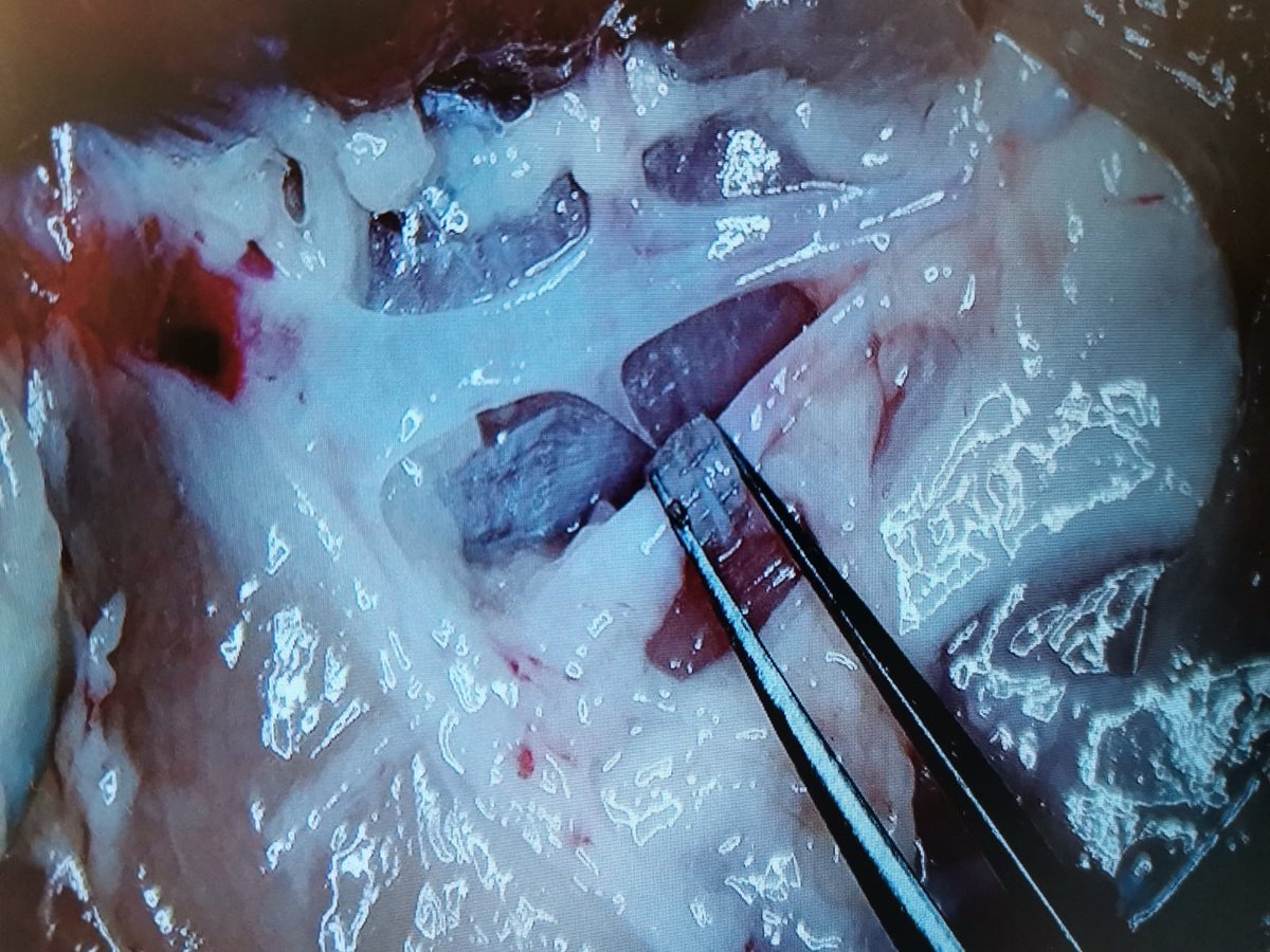 Microsurgery Training Day at the #StokeMandevilleHospital 
@DrJamesKKChan @rebecca5hirley

#Synovis #Coupler #Microsurgery