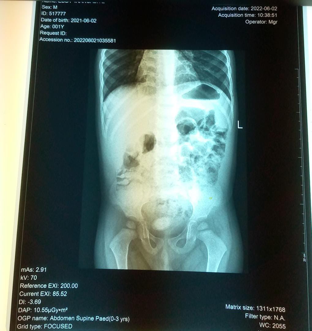 kazobinka_g's tweet photo. Latest record in my stone data…
He is the youngest(1year old) patient I got to treat… the younger patient treated so far was 6years old.
This to say that with this hot season, keep hydrating well and reduce salt consumption.
#Abatwip
#Urinarystone
#Bladderstone https://t.co/0gF0rfKaz6
