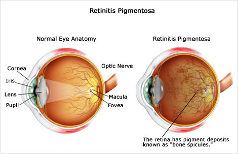 joptoophthal's tweet photo. Retinitis pigmentosa, also called: rod-cone dystrophy is an eye disease in which the back wall of the eye (retina) is damaged. Retinitis pigmentosa is a rare, inherited degenerative eye disease that causes severe vision impairment.
#Retinitispigmentosa #rodconedystrophy https://t.co/EMZGG2VAic