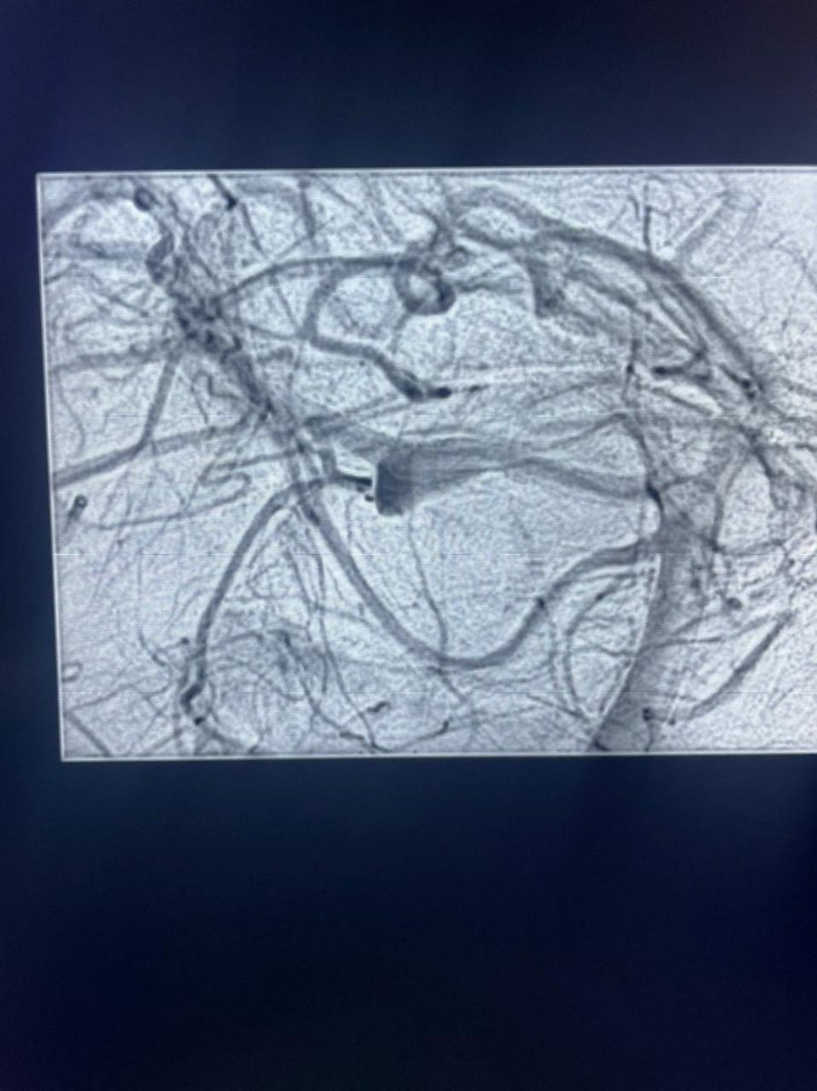 AgrimNeuro's tweet photo. We organised a Neurointervention training workshop with Balt “Practice to Perfection “. Did live cases of flow diverter and stent-assisted coiling. Doctors came from different parts of the country and Nepal! https://t.co/Kzk4A7gLsd