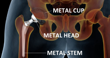 When Can I Return To Yoga Practice After A Hip Replacement? - is.gd/vBvjkO #yogaanatomy #hip #yogainjury #pain