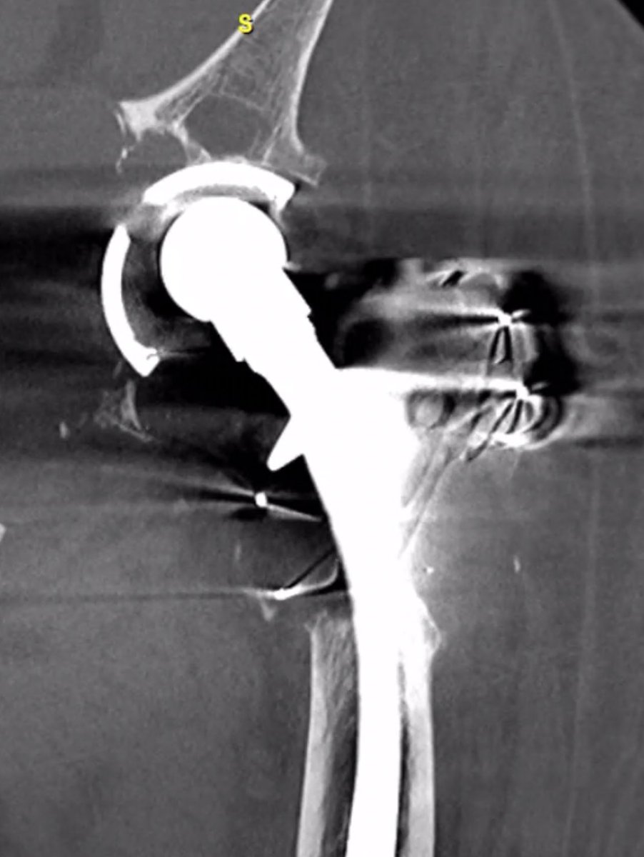 The Tuesday Morning Conference: An 85 year old man presents with pain with weight bearing, now in a wheelchair for one month. History of  L THA in 1988. Options for acetabular reconstruction? @MayoOrthoHipKne <a href="/MayoOrthoRes/">Mayo Orthopedic Residency</a> <a href="/MayoOrthoOnc/">Mayo Clinic Orthopedic Oncology Fellowship</a>