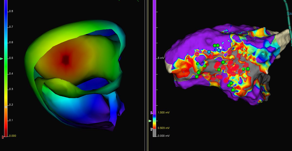 AquilantElectr1's tweet photo. Amazing first case in the Walgrave VIVO trial.  VIVO scar exit site perfectly matched the 3D mapping morphology pace match (blue dots).  Very excited to be working with @DhanjalTarv and #EnsiteX #HDGrid to test the accuracy of the VIVO mapping system! #VIVO #CatheterPrecision https://t.co/yYpHE7dprf