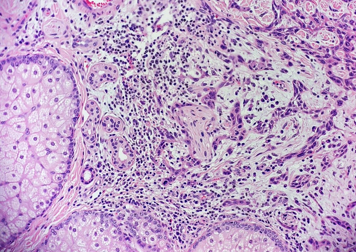 Another nasty one from today's batch. Poorly differentiated #SquamousCellCarcinoma with #PerineuralInvasion. Spot those Schwann cells in trouble.🫣💛💙 
#PathTwitter #Pathology #dermatology