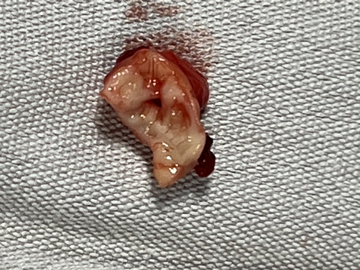 ligia_GL's tweet photo. Coartación aórtica bebé de 3 semanas de vida 🫀🫀 #lovecardio #cardiacanesthesia #CardioTwitter #cardiovascularsurgery #happyplace https://t.co/o9NQB5G6wZ