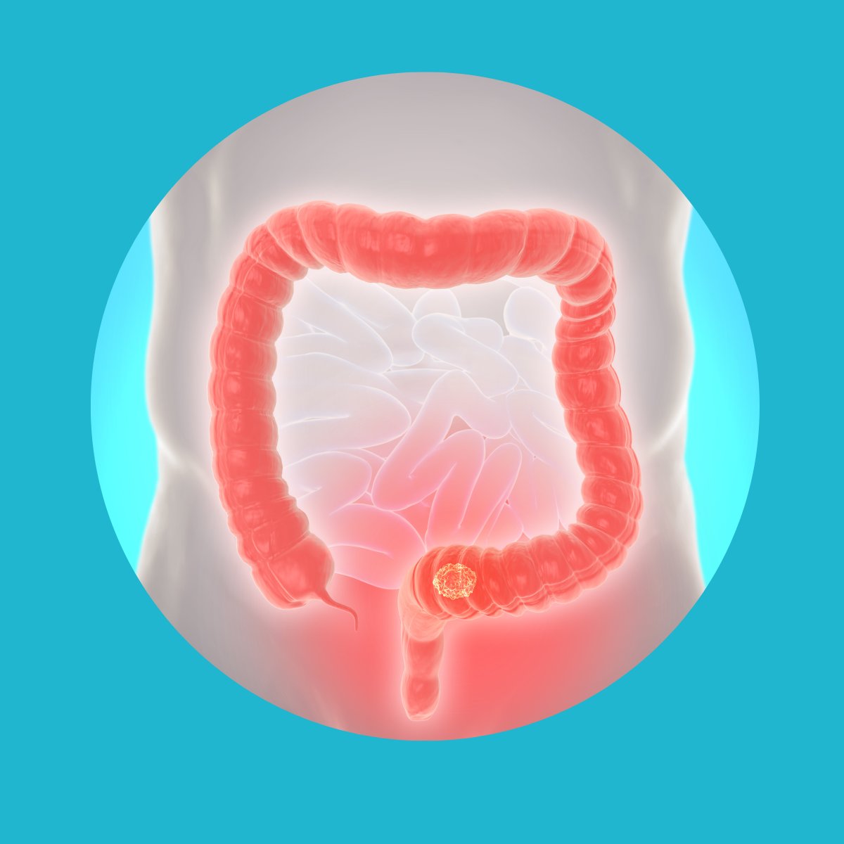 Abyntek's tweet photo. Un fármaco logra remitir por completo el #cáncer rectal en todos los pacientes 👉 https://t.co/9Kq4KYmz0W
 
#CancerRectal #Investigación #Abyntek #Oncología #AnticuerpoMonoclonal #Dostarlimab #PD-1 https://t.co/9ijhqrm1lj