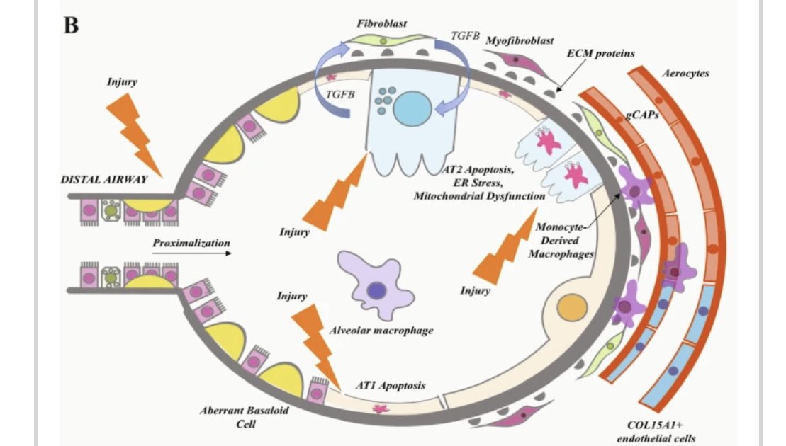 Finally out! Our review “From #COVID19 to fibrosis: lessons from single-cell analyses of the human lung“. Kudos to Dr. Aurelien Justet and #FutureDoubleDoc Amy Zhao. #CurePF #scRNAseq humgenomics.biomedcentral.com/articles/10.11…