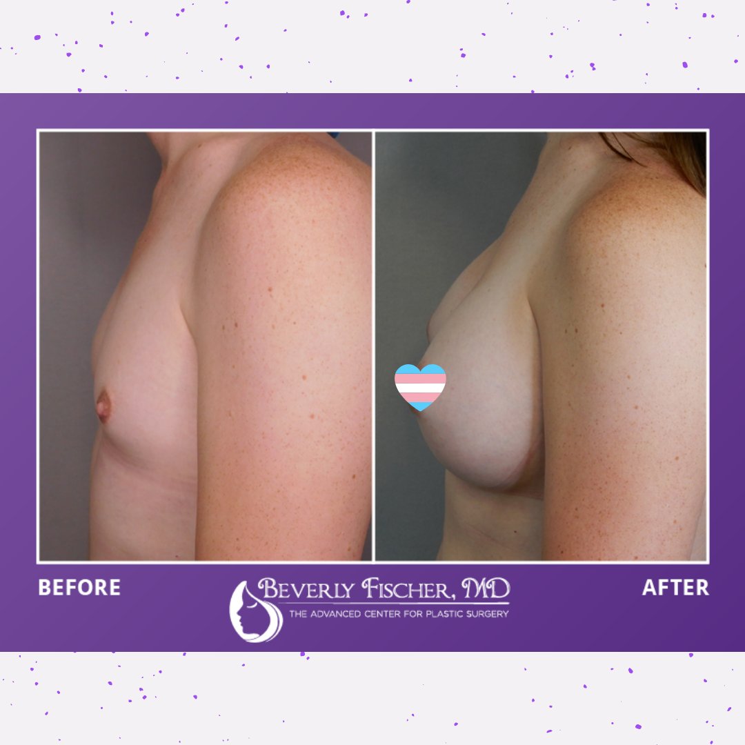 BeverlyAFischer's tweet photo. Dr. Fischer specializes in MTF top surgery and gender affirmation services. Learn more about MTF top surgery and receive $750 off when you schedule your consultation in June! #MTFtopsurgery #genderaffirmation #plasticsurgery #transgenderpride #lgbtq
https://t.co/FcWwcPF7X8 https://t.co/LBabQbLo65
