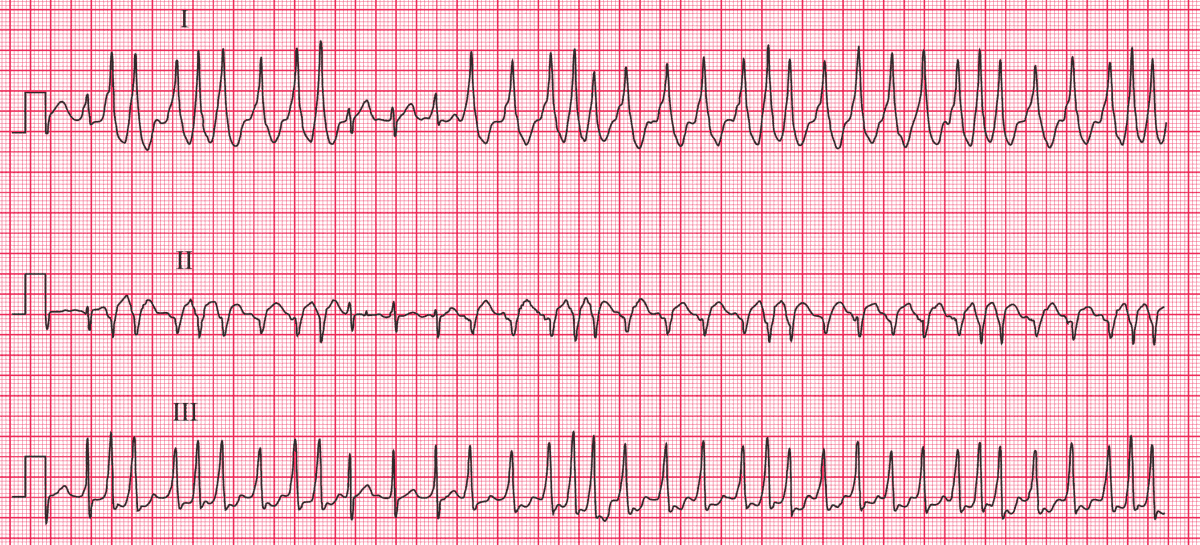 ManualOMedicine's tweet photo. This ECG was recorded from a 20-year-old man who had had attacks of a fast and irregular heartbeat for several years.
- What is the diagnosis and what would you do next?

➡️ Interpretation and Answer: https://t.co/uAtje6G1R0

#meded #foamed #medtwitter #CardioEd #ecg https://t.co/jAPUloU4kK