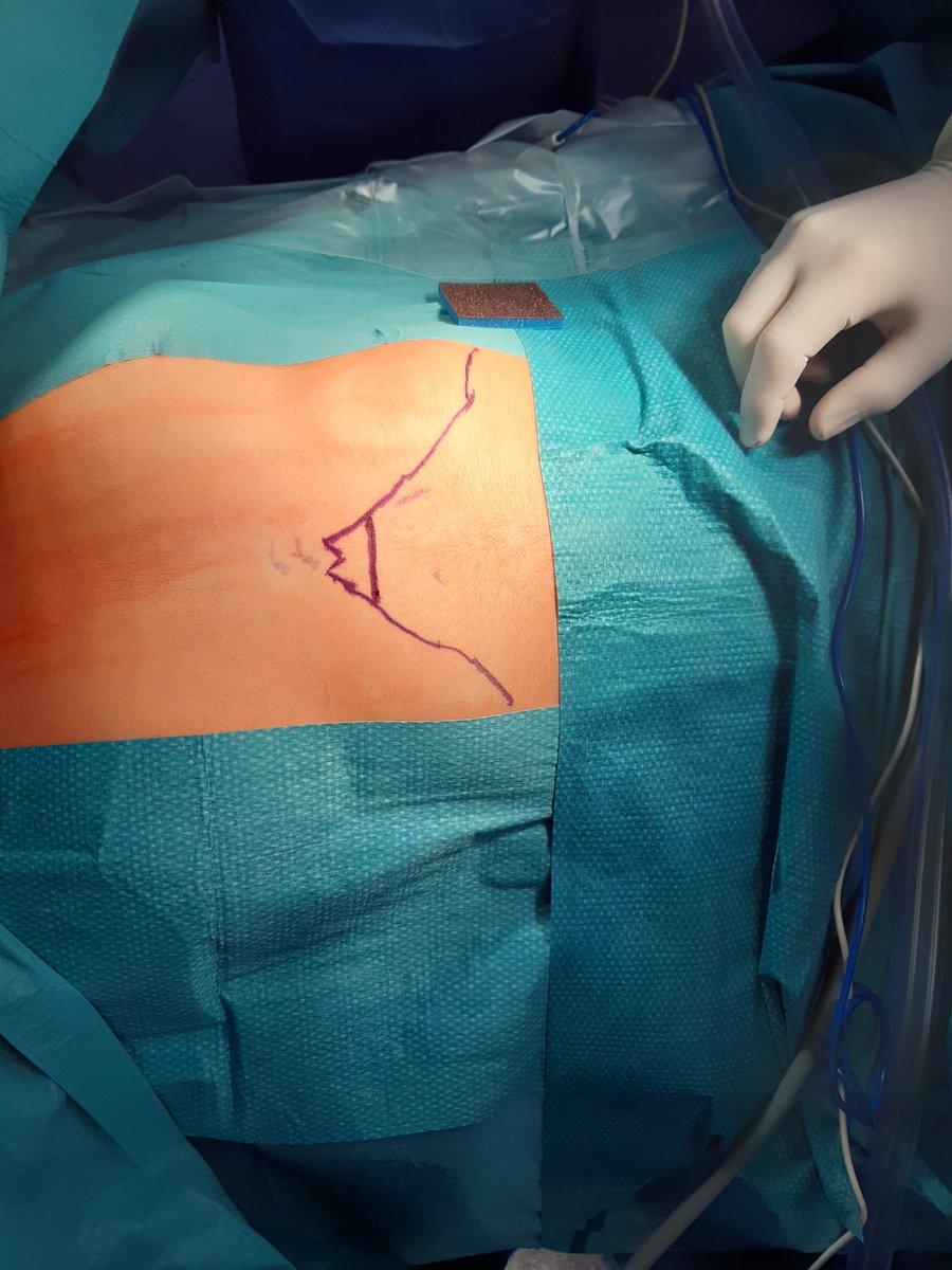 TTrueta's tweet photo. Primera timectomia subxifoidea per miastènia gravis realitzada al Trueta, amb la col.laboració Dr. Sànchez (H. Clínic)
#mínimainvasio
#granequip 
@TTrueta @htrueta @hospitalclinic @ThorSurgHClinic https://t.co/JGmHMFg4wq
