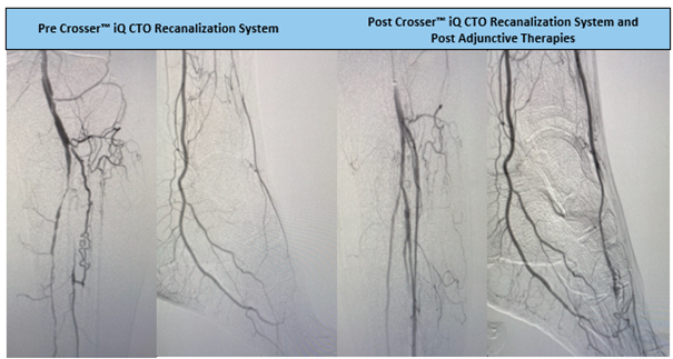 TimHugBD's tweet photo. 25cm CTO case by Dr. Frodsham. Observed a 1 min 7 sec activation time using #CrosseriQ catheter to cross a diseased AT artery, collateral down to the ankle. #CrossThisFast
For use in peripheral artery CTOs; Not for use in carotid arteries. Safety info: https://t.co/1Ziv5usJZZ https://t.co/TniK3nm0L8