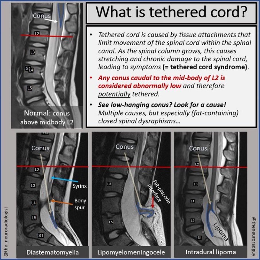 OGdukeneurosurg's tweet photo. A Slide to Save: Every time you assess a lumbar mri for any indication, look for the possibility of a tethered cord w/ any conus extending below L2 mid body. It may  be more occult than these w/ fatty filum. You’ll need to adjust your workup &amp; surgical plan accordingly. https://t.co/UZrYBrGMVh
