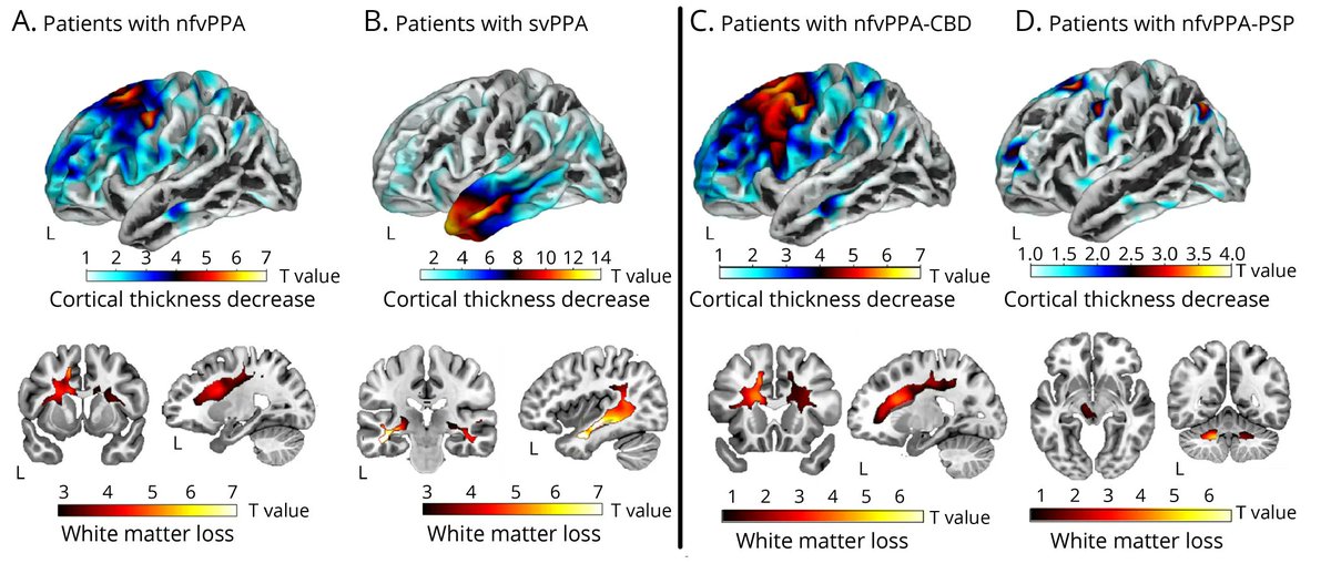 UCSF MAC (@ucsfmac) on Twitter photo Automated Detection of Speech Timing Alterations in Autopsy-Confirmed Non-fluent/agrammatic Variant Primary Progressive Aphasia. Capture nfvPPA markers & discriminate tauopathies. bit.ly/3aSdDPW
<a href="/AdolfoMGarcia/">Adolfo García</a> <a href="/arianewelch/">arianewelch</a> <a href="/AlbaLanguage/">ALBA Language Neurobiology laboratory</a> @utaphasialabs <a href="/brucemillerucsf/">Bruce Miller</a> Automated Detection of Speech Timing Alterations in Autopsy-Confirmed Non-fluent/agrammatic Variant Primary Progressive Aphasia. Capture nfvPPA markers & discriminate tauopathies. bit.ly/3aSdDPW
<a href="/AdolfoMGarcia/">Adolfo García</a> <a href="/arianewelch/">arianewelch</a> <a href="/AlbaLanguage/">ALBA Language Neurobiology laboratory</a> @utaphasialabs <a href="/brucemillerucsf/">Bruce Miller</a>
