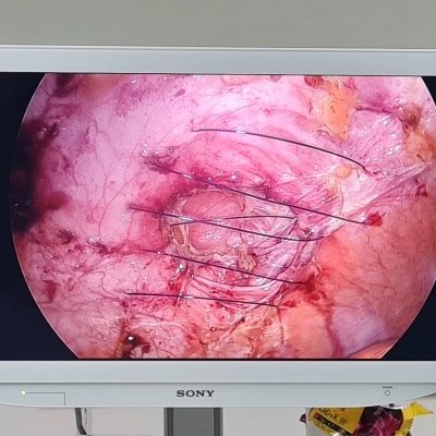 fitikistanbul's tweet photo. #IPOMplus - Karın ön duvarı fıtıklarında hedef defektin kapatılması. Obez hastalarda #LaparoskopikCerrahi ile onarım üstün. 

#FıtıkCerrahisi #FıtıkAmeliyatı #AmeliyatFıtığı #SadeceBirFıtıkDeğil https://t.co/EDFZNAxNLz