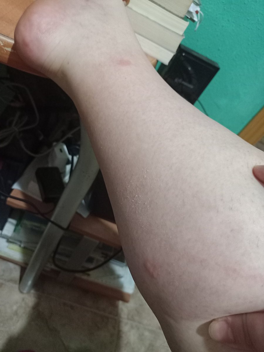 neussgutierrez's tweet photo. Llego la temporada de que me coman 😭 y así no vida, así no, si me van a comer q sea un maromo de bien 🙄🙄 #putosmosquitos https://t.co/iKcI6FVS1C