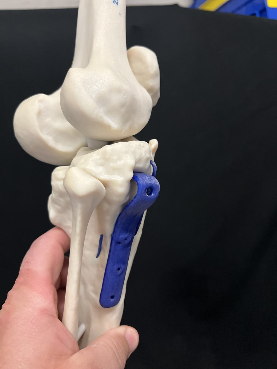 JayMorris_MD's tweet photo. Post operative osteotomies of the tibia can be complex if there is existing hardware and multiple previous surgeries. Digital planning combined w/ #3Dprinted patient #digitaltwins are helpful in #planning #education &amp; #intraop reference. #orthotwitter @MayoOrthoRes #3D #knee #AR https://t.co/QtATruYgvc
