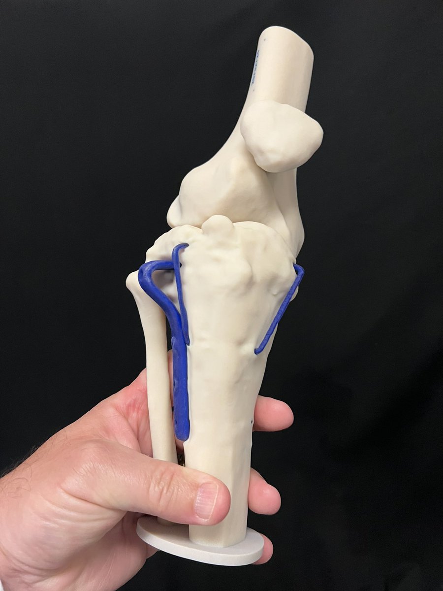 JayMorris_MD's tweet photo. Post operative osteotomies of the tibia can be complex if there is existing hardware and multiple previous surgeries. Digital planning combined w/ #3Dprinted patient #digitaltwins are helpful in #planning #education &amp; #intraop reference. #orthotwitter @MayoOrthoRes #3D #knee #AR https://t.co/QtATruYgvc