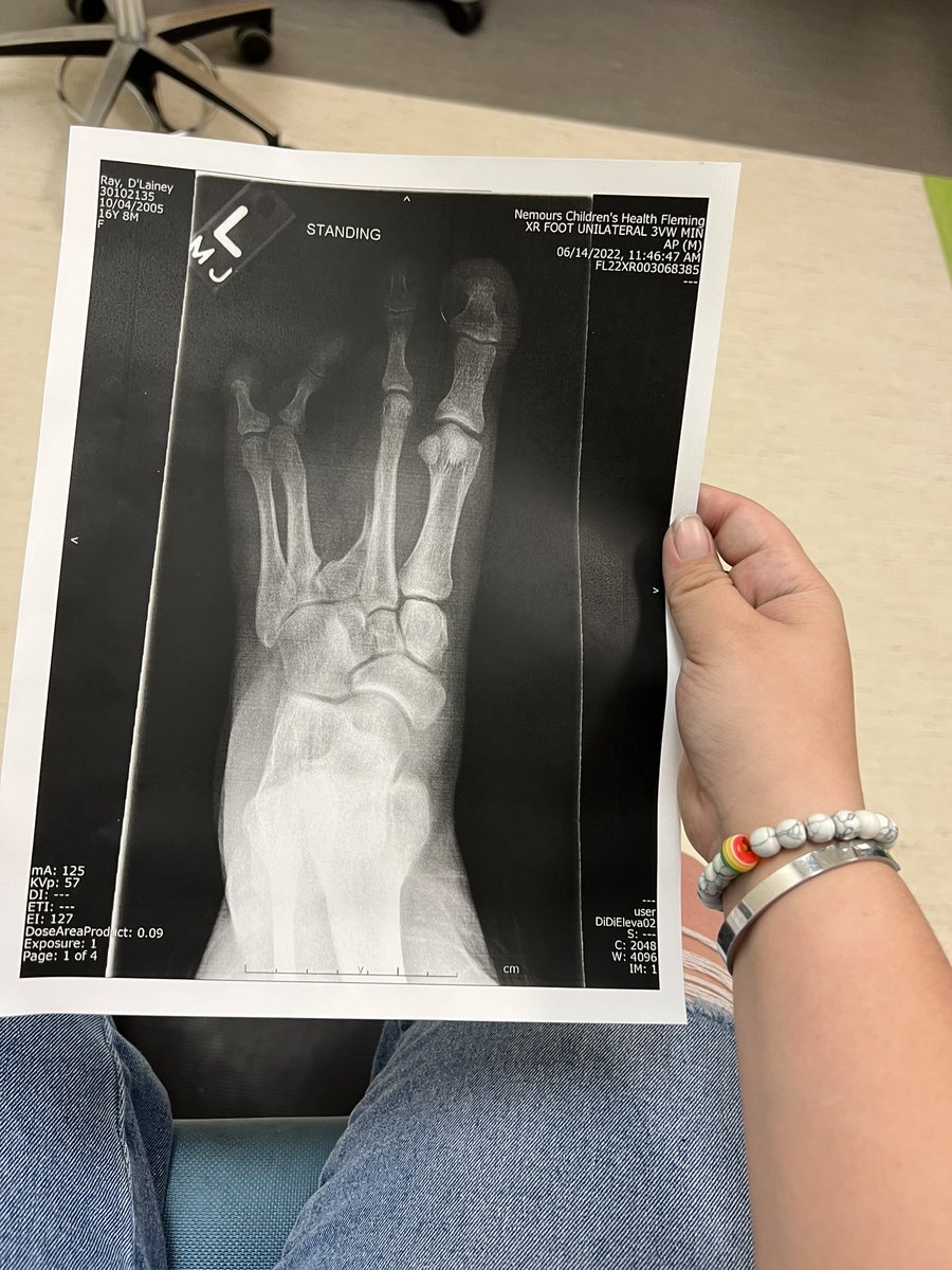 Smol_Scout's tweet photo. Tw// medical stuff???

LOOK AT MY X-RAY ISNT IT SO COOL AND WEIRD???

That being said, I have a surgery in July :] https://t.co/Ox63x8OMUz