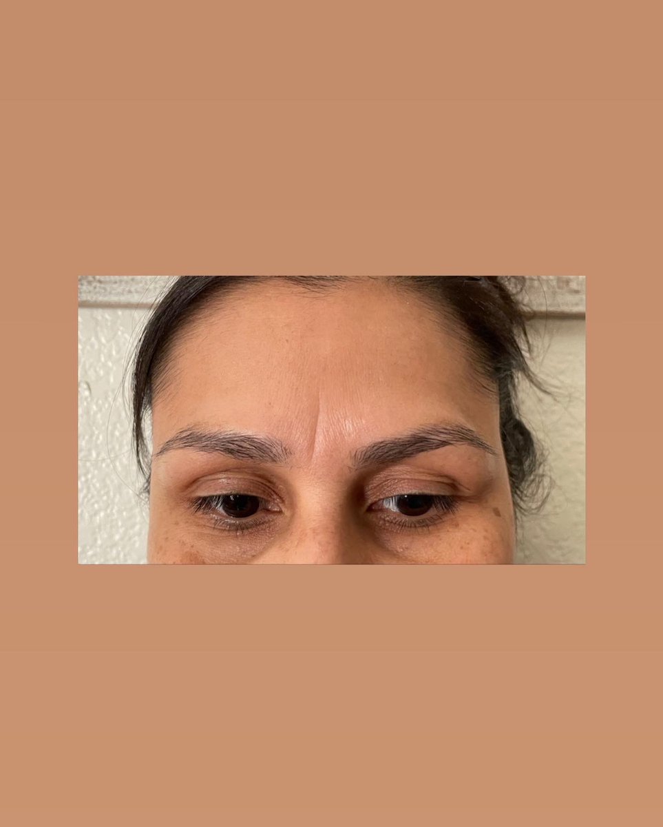 vicctorriaaaaa's tweet photo. Hey I’m looking for new clients! I’m in the LA County area, and this is my first clients healing progress after her first microblading procedure a month ago!😍 still practicing but pls feel free to dm me to book🤍 she still has her 10 week touch up coming soon!🥰 https://t.co/sSQQOHgS1V