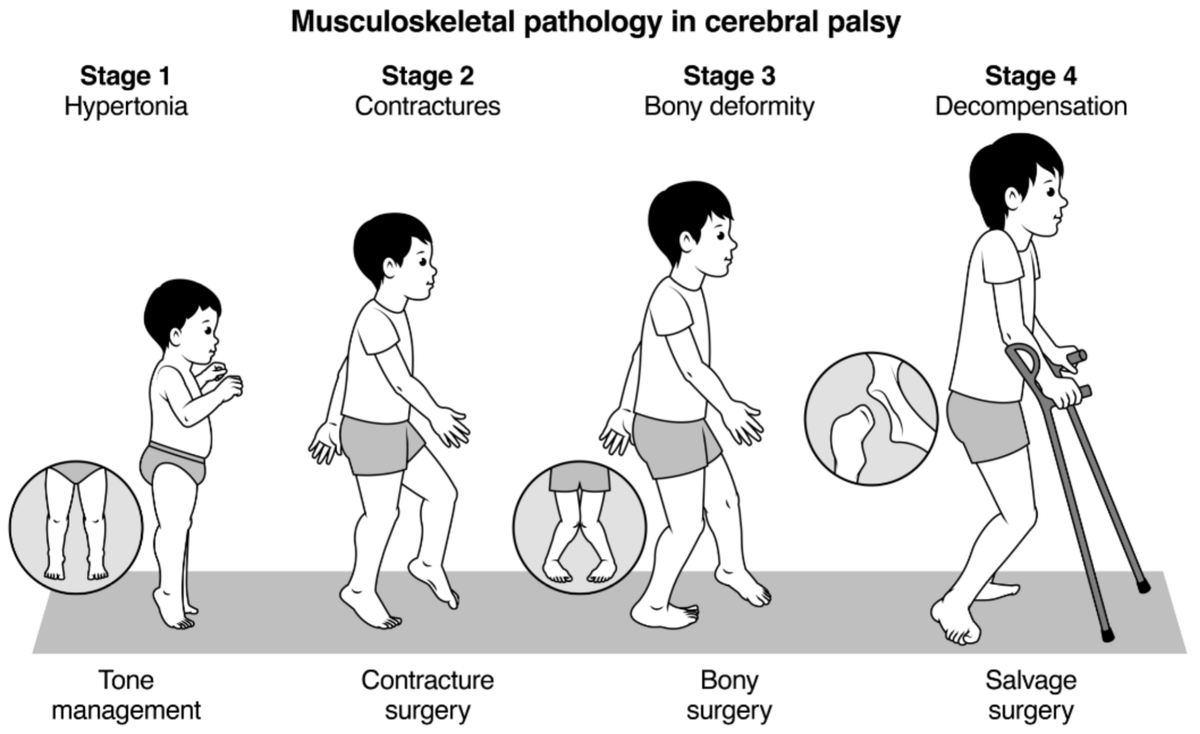 Children_MDPI's tweet photo. #mdpichildren Read the High Cited Paper "Musculoskeletal Pathology in Cerebral Palsy: A Classification System and Reliability Study"

More: https://t.co/1yXwzgRyKg

#cerebralpalsy #CP #musculoskeletalpathology #spasticity #contracture #deformity #decompensation https://t.co/68FWjGsyXi