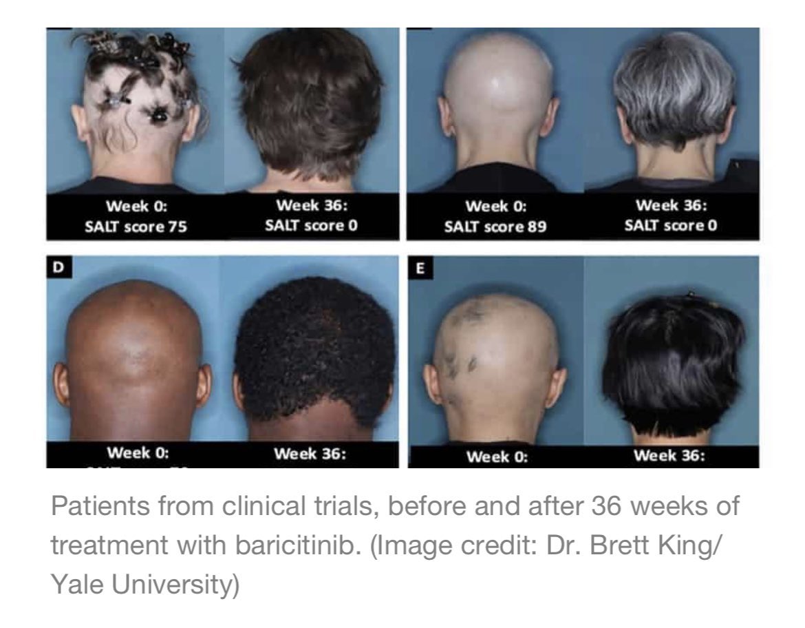 Ayer, la FDA aprobó oficialmente Baricitinib, un inhibidor oral de JAK aprobado para la alopecia areata avanzada. Pasa a ser el primer tratamiento aprobado en la Alopecia Areata (enfermedad autoimmune que afecta el 1-2% de los pacientes del 🌎)👏🏼🤩