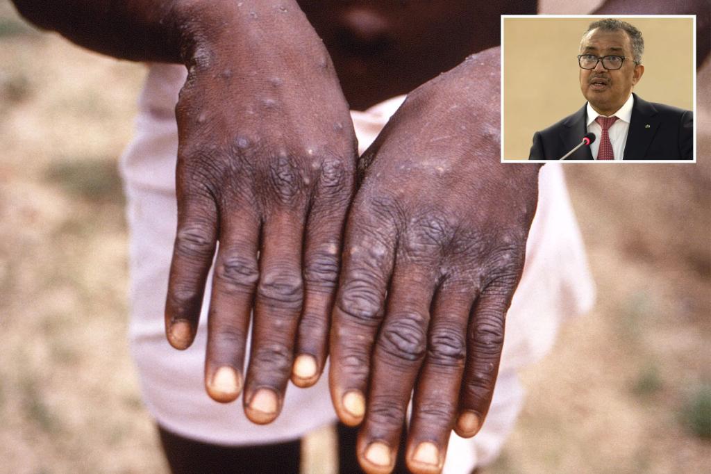 nypost's tweet photo. WHO to rename monkeypox after scientists complain label 'stigmatizing' https://t.co/TAK7qtUWJt https://t.co/n4m2bNx0PZ