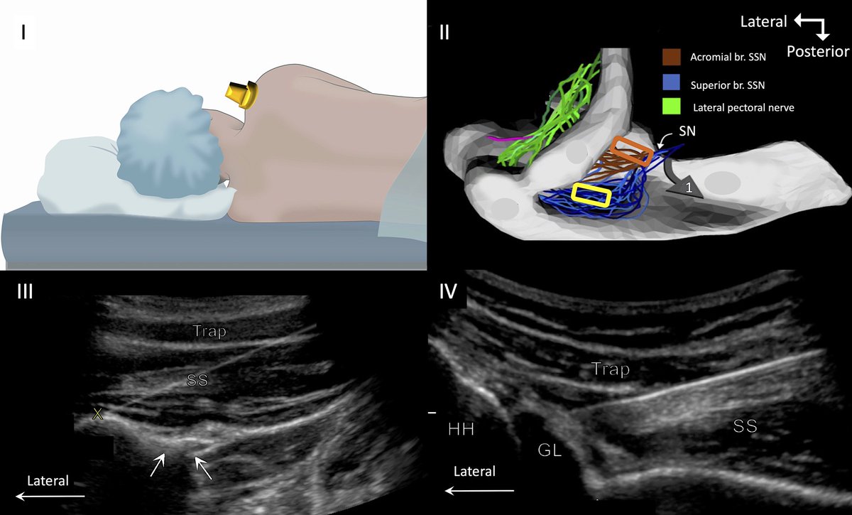 Super-excited about this article. After detailing the innervation of shoulder 2 yr ago, I investigated so many different approaches to SHD denervation and this one WORK!
Cryoanalgesia for shoulder pain: a motor-sparing approach to rotator cuff disease  rapm.bmj.com/content/early/…