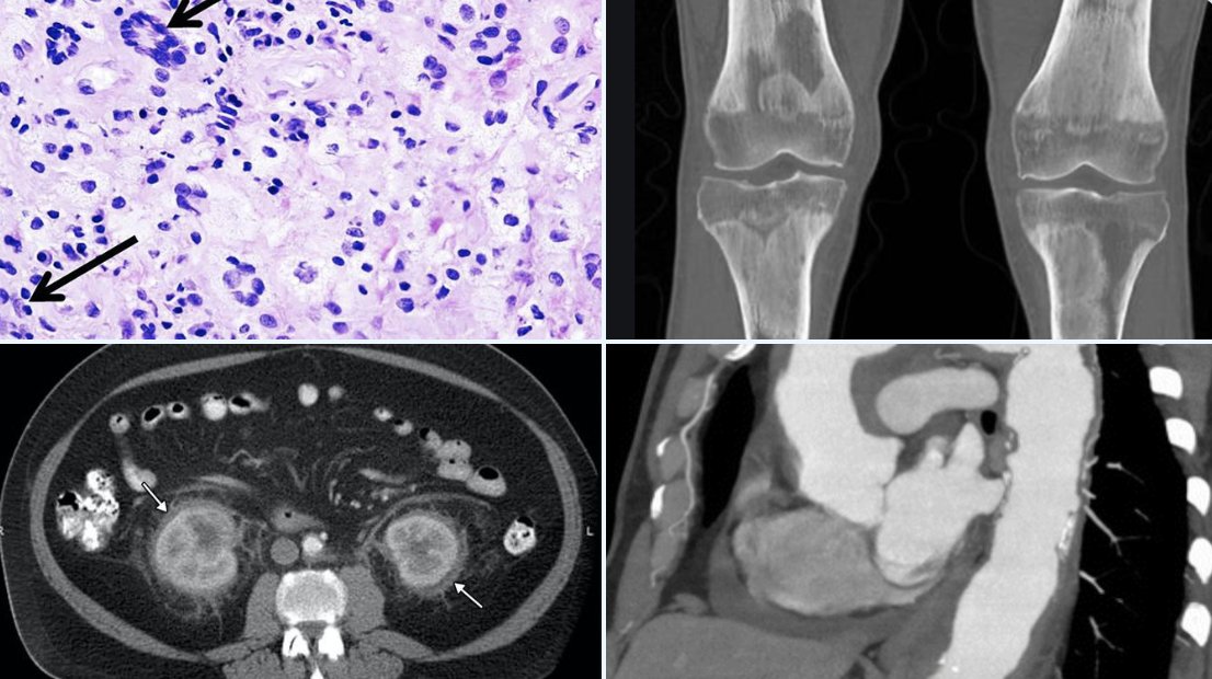 My goal is for all of med twitter to look at these 4 images and know the diagnosis. The more docs that think about this disease than the more cases we will pick it up. It is very treatable.
