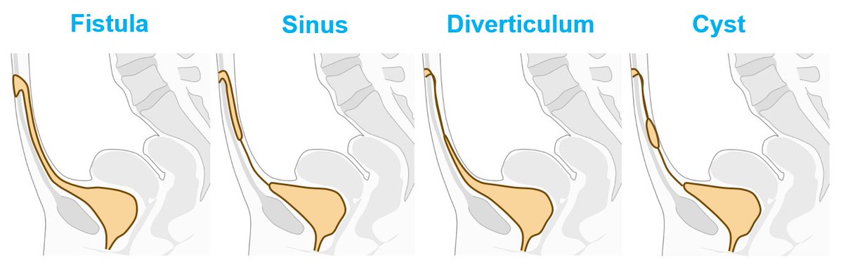 Omphalitis is a local inflammation of the umbilicus. A differential of the urachus sinus, one of the pathologies of the umbilical ligament (urachus) that must be known by all #uroradiologists. Diagnosis facilitated by #spectralimaging. To be followed by #MRI after local treatment