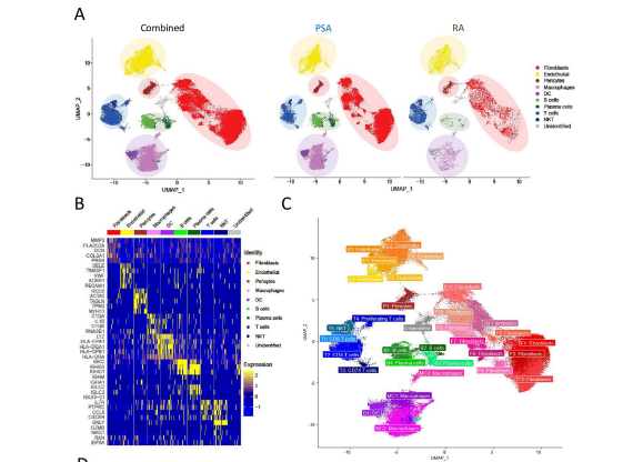 MolecularTcd's tweet photo. 📢Delighted to see our paper published today: First in-depth  single cell analysis of the synovium demonstrating a differential cellular landscape in RA vs PsA. #rheumatology #SynovialFibroblasts #synovium #scRNAseq 🧵
➡️https://t.co/I4C6txwExp https://t.co/0gKHkYfOo0