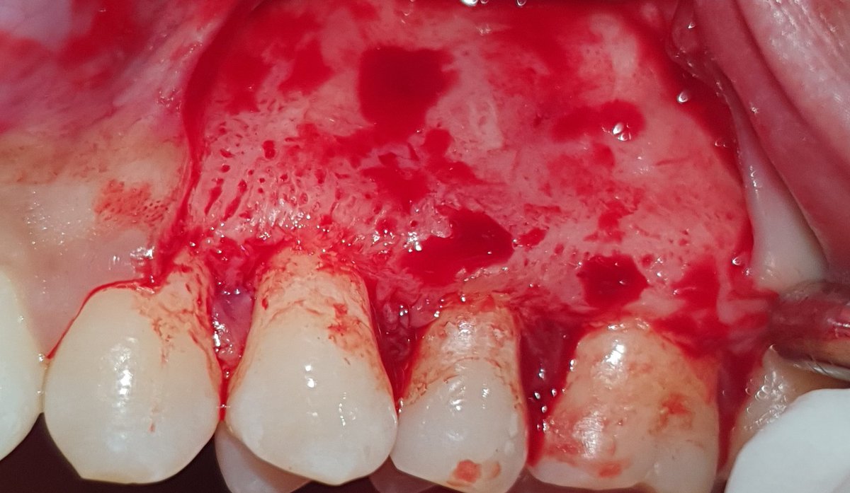 aypzp's tweet photo. #periapicallesion, #periapicalsurgery #diplomadoscood, #bonegraft, #orslsurgerystudentwork https://t.co/lhRZGnvvFF
