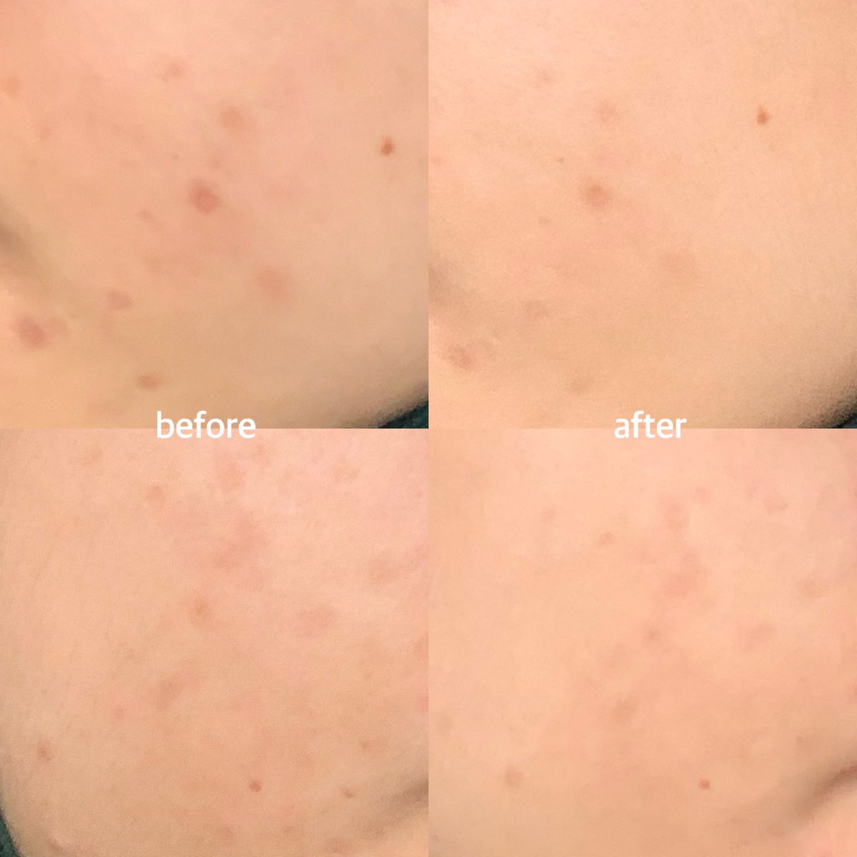 kejumini's tweet photo. [Review]

Lagi suka banget dengan kondisi kulit di bulan inii (ʃ⌣ƪ)

Sejak pakai Retinol Renewal Serum, kulit jadi jarang banget bruntusan. Bekas jerawat juga lebih cepat memudar, lhoo.

Yuk kita bahas produk retinol dari Pratista ini (>̯-̮<)

#racuninskincare https://t.co/OSSCCkYfcd