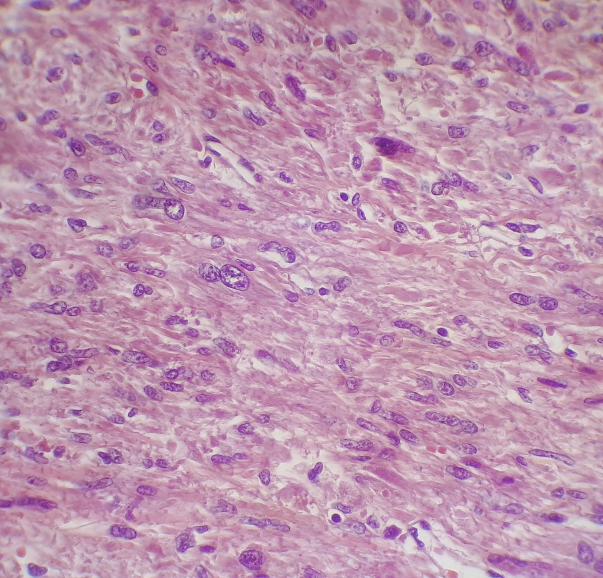 otromicroscopio's tweet photo. Uterine smooth muscle tumour showing staghorn vessels and some atypical nuclei. No mitosis. No necrosis. What's your diagnosis? Would this findings urge you to order any extra stain? #GynPath https://t.co/Bj1hVJ2pWy