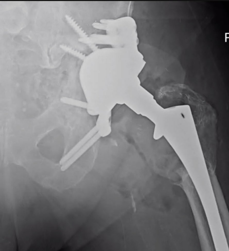 The custom triflange acetabular component is a reliable option in cases of severe acetabular bone loss.  As advances in additive manufacturing continue, custom reconstructive options for bone loss may become faster and more cost effective.