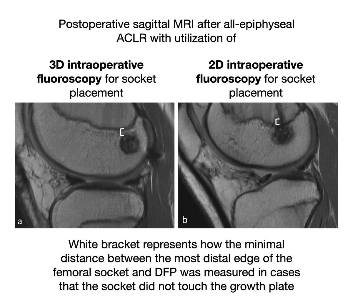 KSSTA's tweet photo. This study showed that surgeons should consider utilizing 3D imaging prior to creating femoral and tibial sockets to potentially decrease the risk of physis violation in pediatric patients undergoing ACL-R

#sportsmedicine #growtharrests #ACLrehab

Link: https://t.co/b9T2JUDPf9 https://t.co/o1BZD3JypV