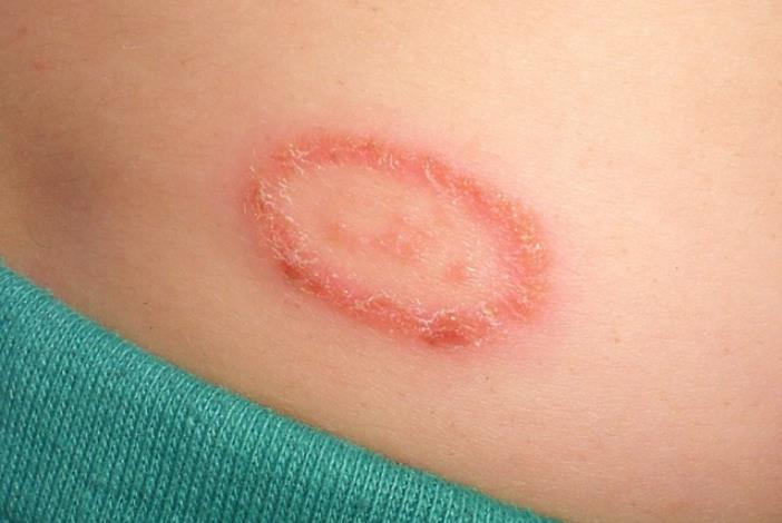 Streamingmedics's tweet photo. Seborrheic dermatitis may go away without treatment. Or you may need many repeated treatments before the symptoms go away. ==>>https://t.co/MOsrNUJ1F3 #Seborrheic https://t.co/2x8Yv98dqt