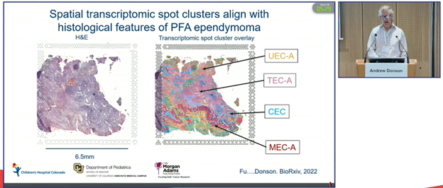 MorganAdamsFdn's tweet image. Nicholas Willard and Andy Donson presented in separate #ISPNO2022 sessions about spatial transcriptomics in medulloblastoma and ependymoma this morning. We are fortunate to have Visium platform in CO to advance knowledge of pediatric brain cancers alongside single-cell sequencing